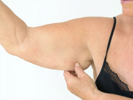 lifting des bras