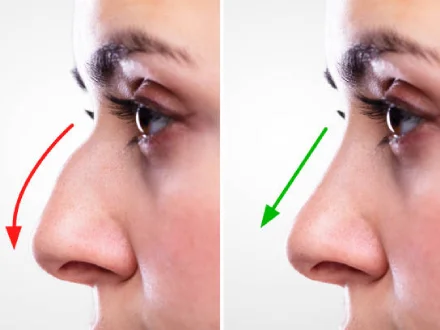 rhinoplastie