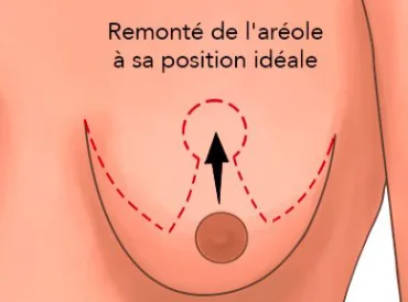 sutures